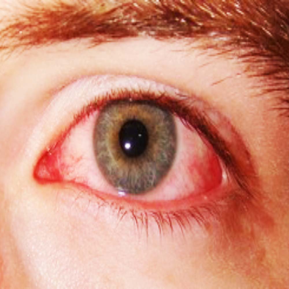 Sindrome de Sjogren Artritis reumatoide